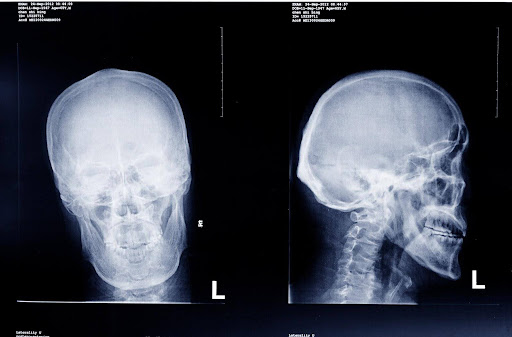 An X-ray of a human head; closed head injuries do not penetrate the skull, but can still lead to permanent damage.